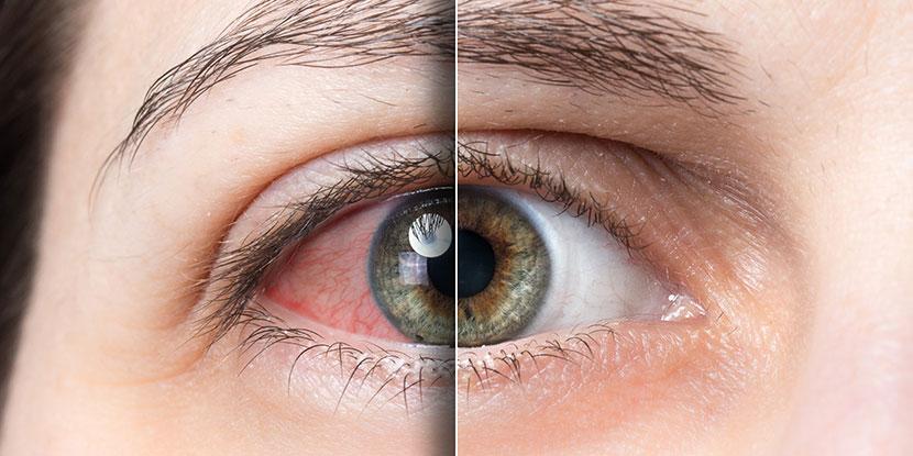 Dry eye is a condition where there is insufficient lubrication and moisture on the surface of the eye.